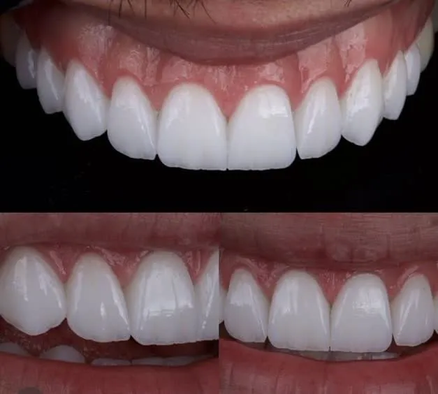 تفاوت لمینت و کامپوزیت دندان چیست؟